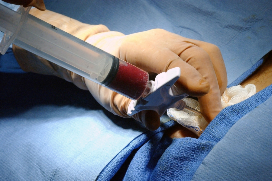 Процесс получения стволовых клеток из пуповинной крови